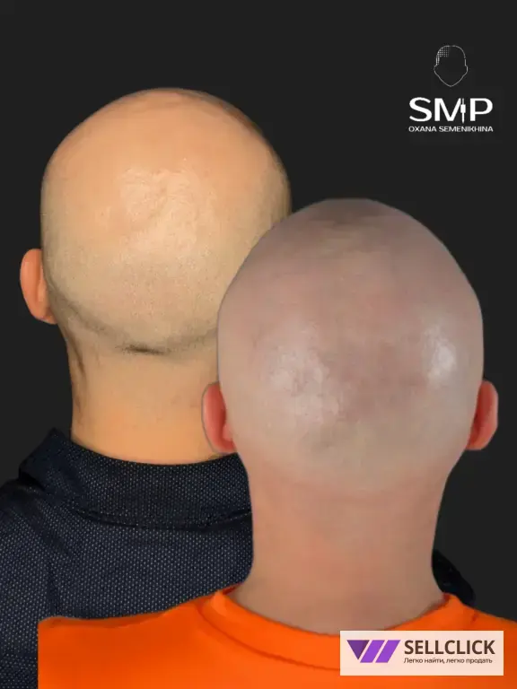 Трихопигментация: для лысины, залысин и маскировки шрамов после пересадки
