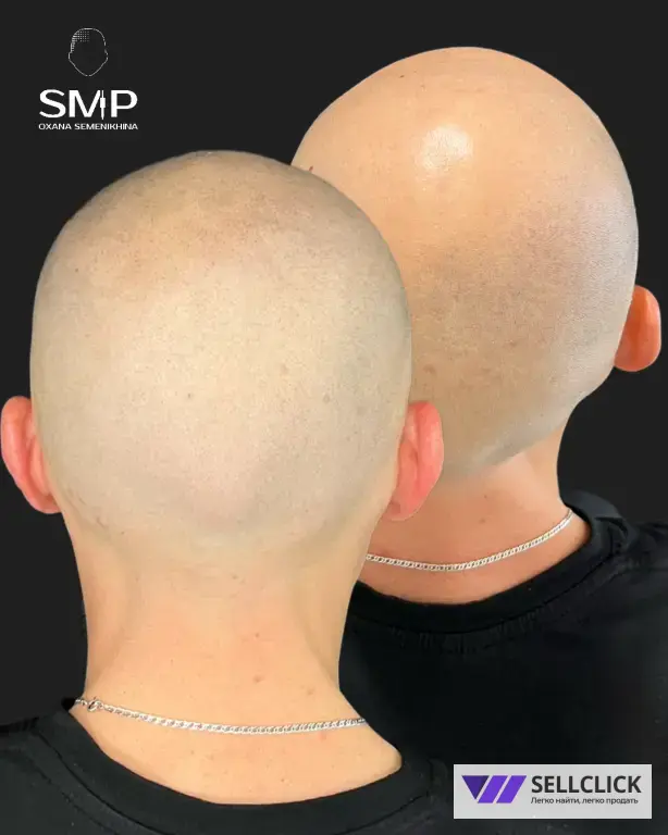Трихопигментация: для лысины, залысин и маскировки шрамов после пересадки