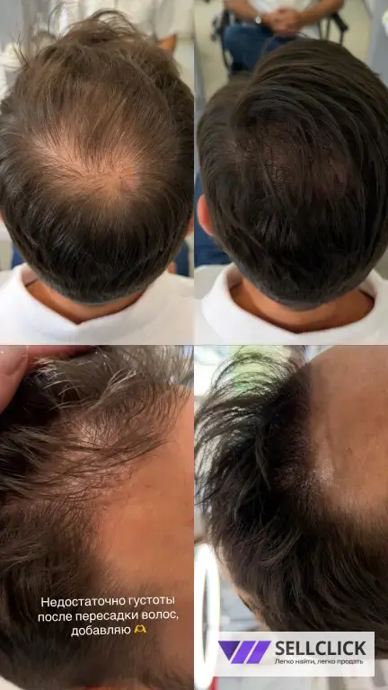 Трихопигментация: для лысины, залысин и маскировки шрамов после пересадки