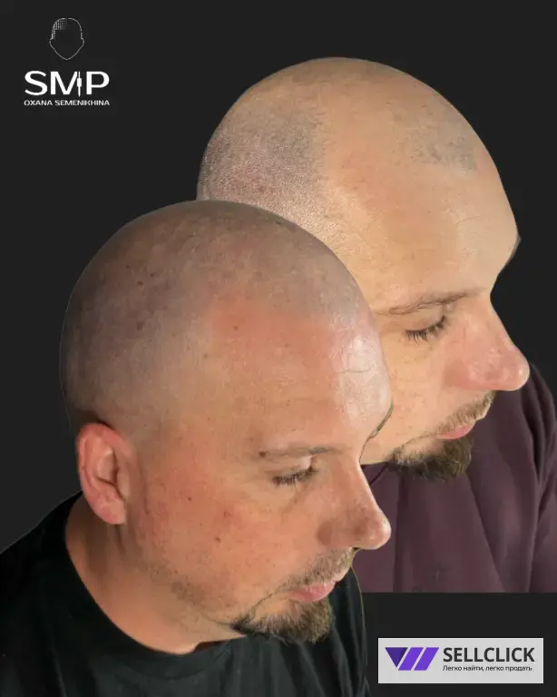 Трихопигментация: для лысины, залысин и маскировки шрамов после пересадки