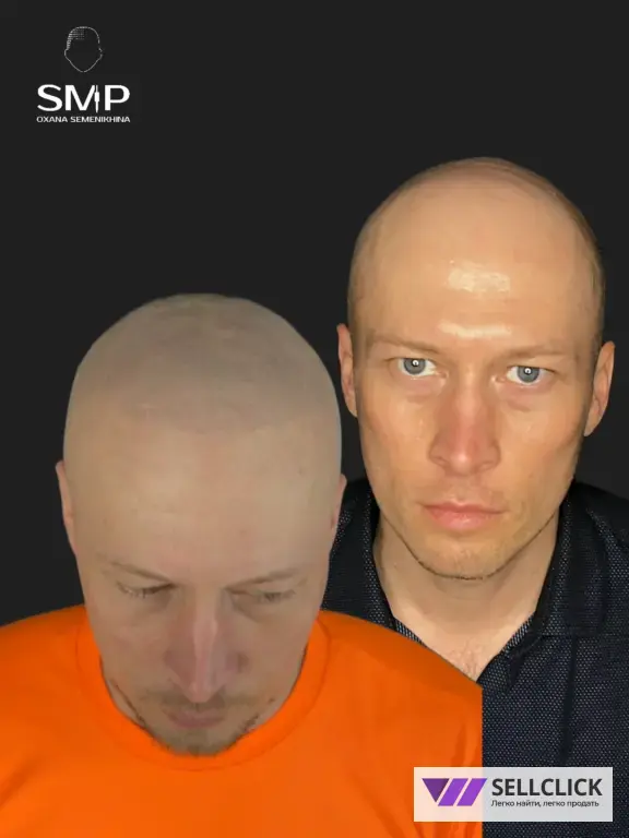 Трихопигментация: для лысины, залысин и маскировки шрамов после пересадки