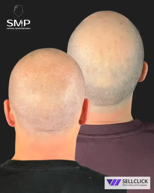 Трихопигментация: для лысины, залысин и маскировки шрамов после пересадки
