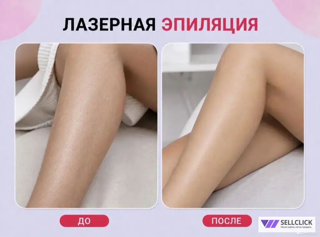 лазерная эпиляция