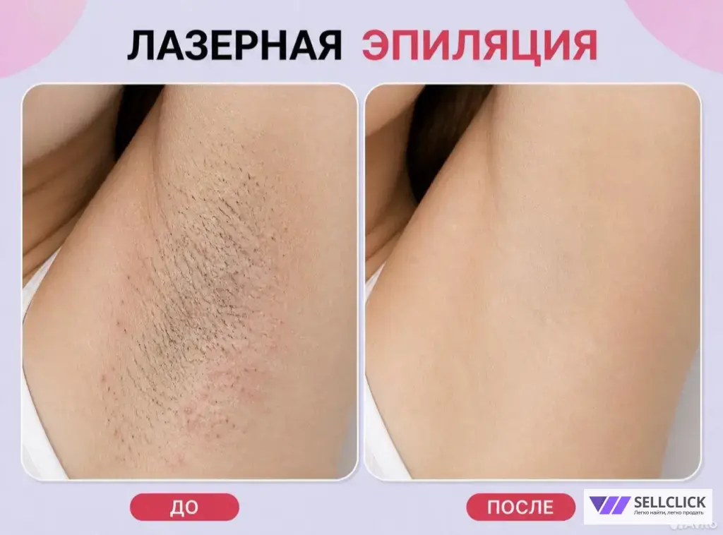 лазерная эпиляция