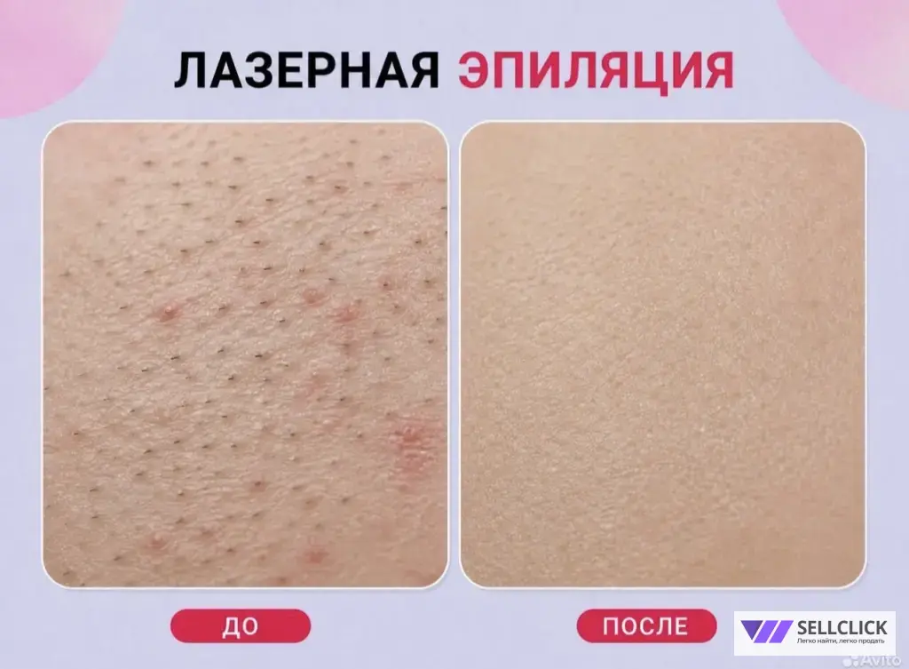 лазерная эпиляция