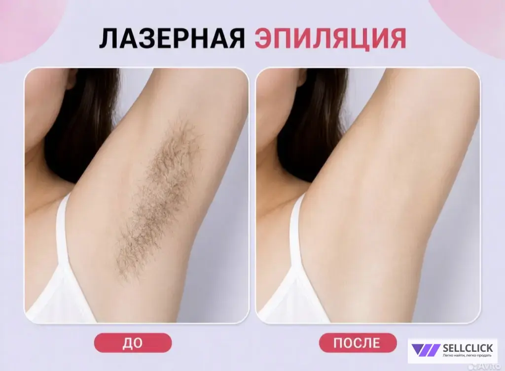 лазерная эпиляция