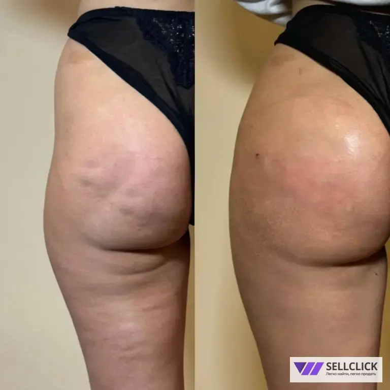 Увеличение губ Нити увеличение ягодиц Ботокс