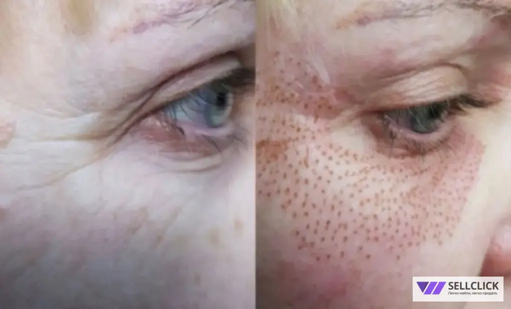 удаление новообразований