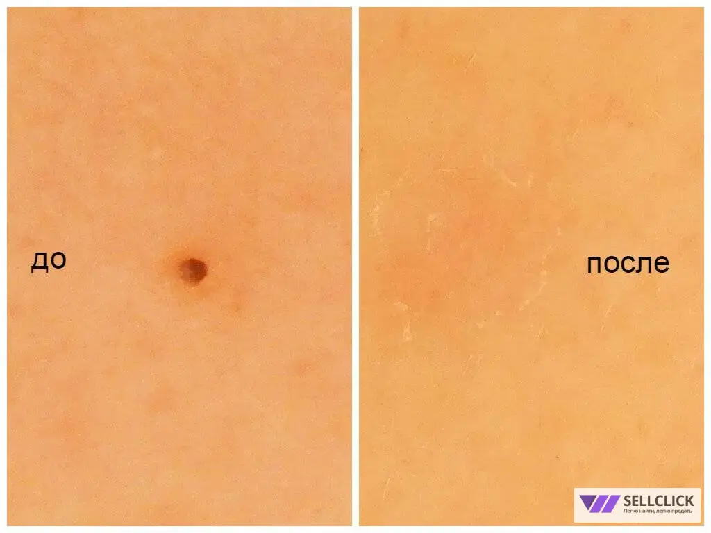 удаление новообразований