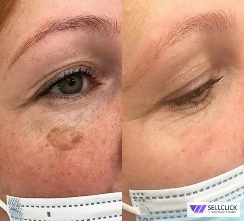 удаление новообразований