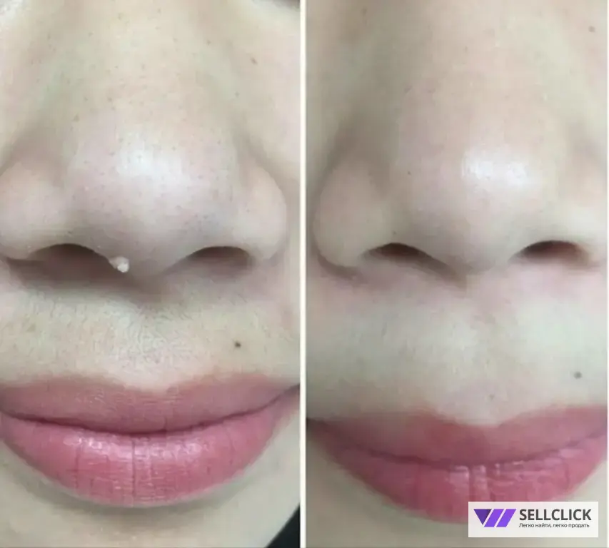 удаление новообразований