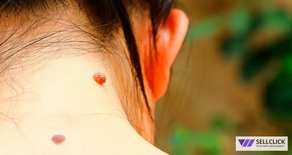 удаление новообразований