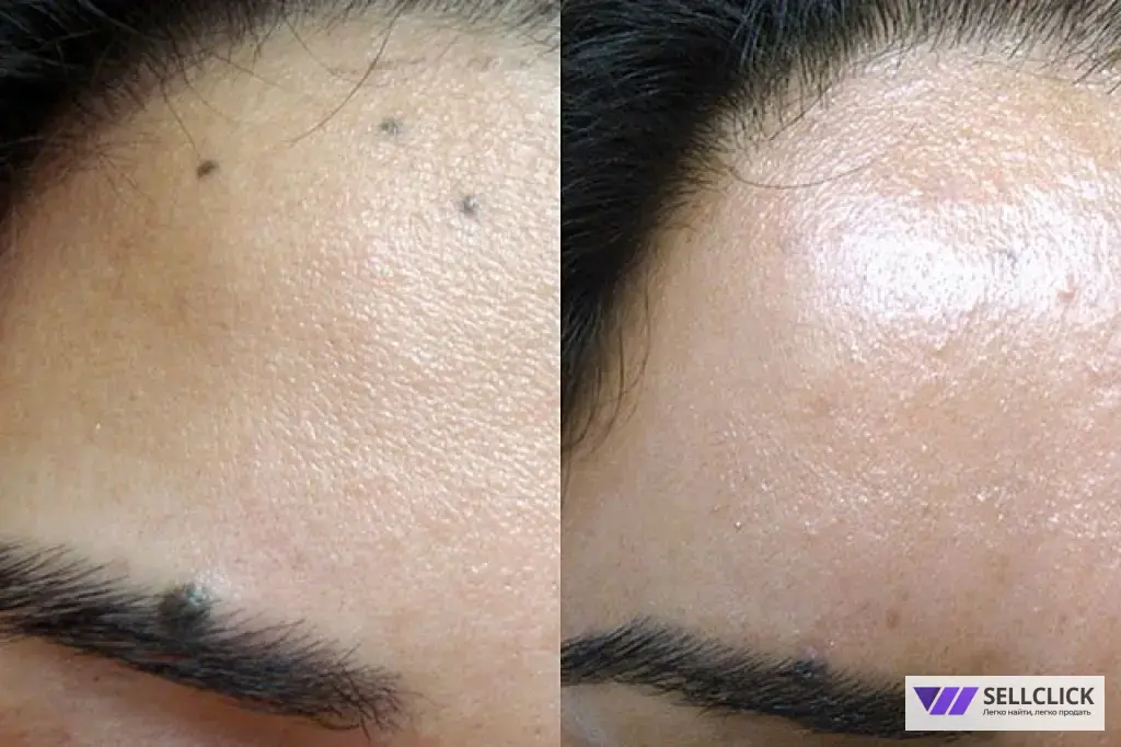 удаление новообразований