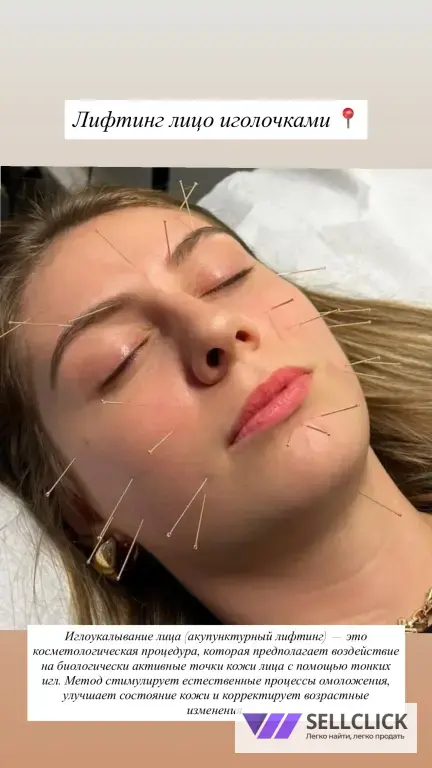 Иглоукалывание !