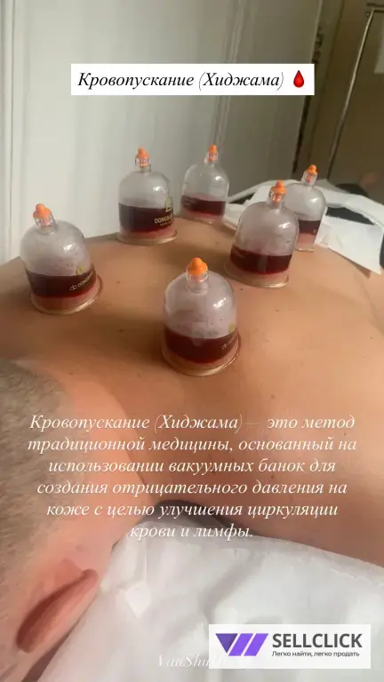 Иглоукалывание !