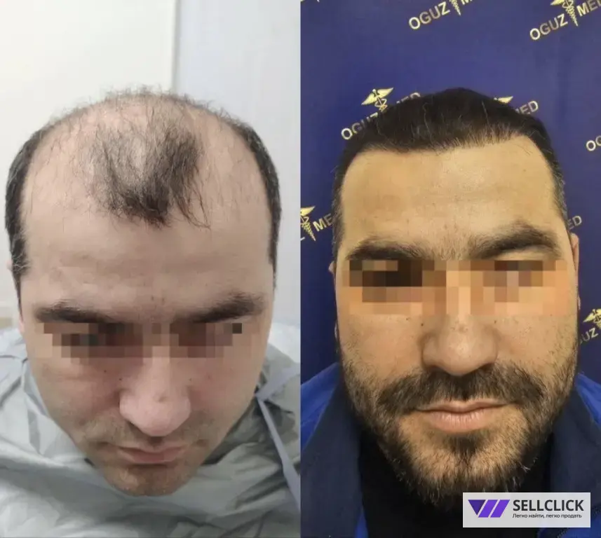 пересадка волос, бороды и бровей