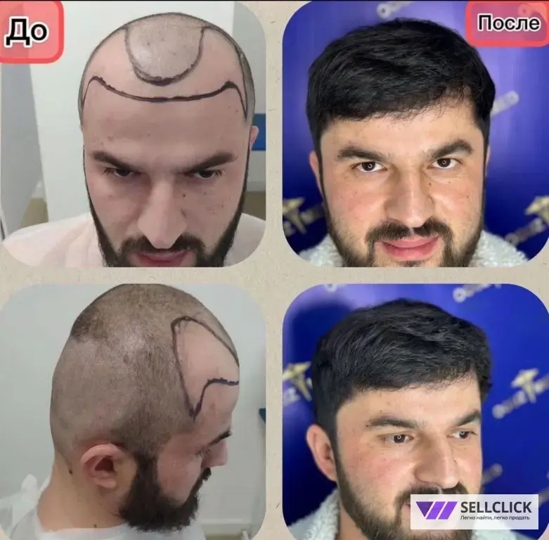Пересадка волос, бороды и бровей