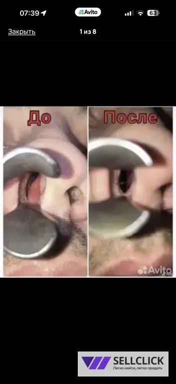 СЕПТОПЛАСТИКА БЕЗ ОПЕРАЦИИ